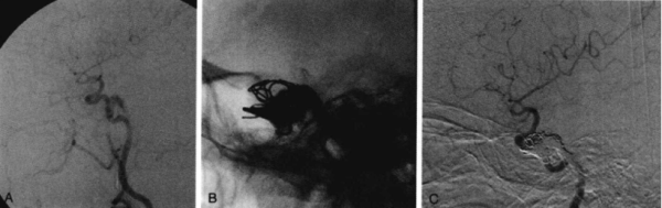 众银策略 患者头痛、复视，根据影像，诊断考虑是？